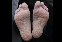 Pide IMSS Veracruz Norte prevenir padecimiento conocido como Pie trinchera