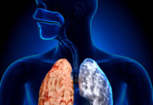 Invita IMSS Veracruz Norte a prevenir Enfermedad Pulmonar Obstructiva Crónica
