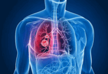 Informa IMSS Veracruz Norte importancia de prevenir neumonía