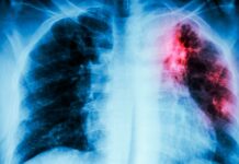 Veracruz, primer lugar nacional en casos de tuberculosis respiratoria