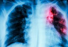 Veracruz lidera incidencia nacional en tuberculosis, parasitosis intestinales y ETS