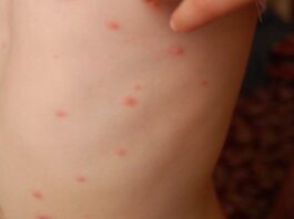 Se dispara el número de casos de varicela en Veracruz