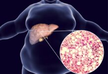 Recomienda IMSS Veracruz Norte alimentación saludable para prevenir hígado graso