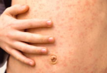 Reporta Salud 5,860 casos de sarampión en el país; Veracruz, sin presencia de la enfermedad