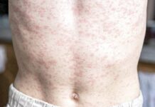 Alerta epidemiológica por sarampión; se registra el primer caso en Veracruz