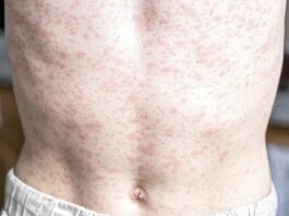 Alerta epidemiológica por sarampión; se registra el primer caso en Veracruz