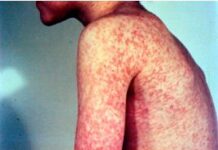 Detectan 63 casos sospechosos de sarampión en Veracruz; hay 3 confirmados