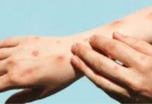 Se disparan los casos de viruela símica en Veracruz