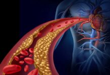 Recomienda IMSS Veracruz Norte hábitos saludables para prevenir colesterol y triglicéridos elevados