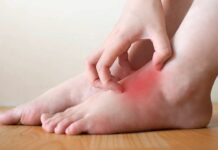 Invita IMSS Veracruz Norte a tratar pie de atleta