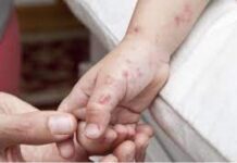 Veracruz, quinto estado con más casos de varicela