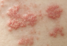 Informa IMSS Veracruz Norte sobre herpes genital