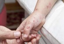 Veracruz, quinto estado con más casos de varicela