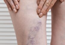 Detectar várices de manera oportuna previene complicaciones: IMSS Veracruz Norte