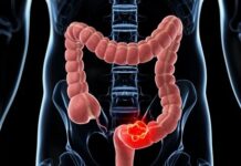 Destaca UMAE del IMSS Veracruz Norte importancia de detección oportuna de cáncer de colon y recto