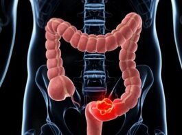 Destaca UMAE del IMSS Veracruz Norte importancia de detección oportuna de cáncer de colon y recto