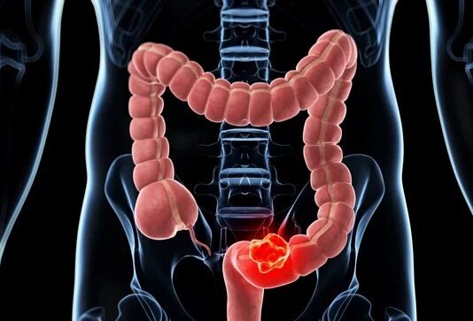 Destaca UMAE del IMSS Veracruz Norte importancia de detección oportuna de cáncer de colon y recto