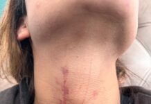 Excandidata a alcaldía de Xalapa recibe brutal golpiza por su pareja; exige justicia