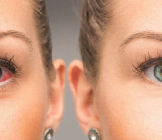 Advierte IMSS Veracruz Norte sobre síntomas de Glaucoma