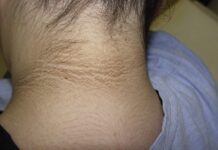 Identificar oportunamente la resistencia a la insulina, previene diabetes tipo II: IMSS Veracruz Norte