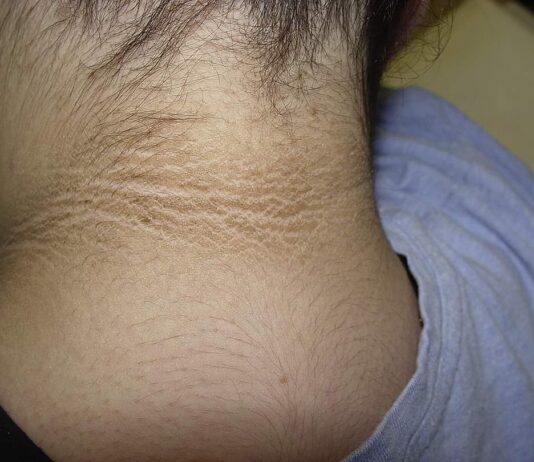 Identificar oportunamente la resistencia a la insulina, previene diabetes tipo II: IMSS Veracruz Norte