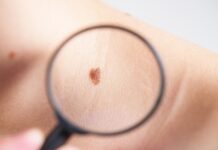 Advierte IMSS Veracruz Norte respecto a la aparición de melanoma