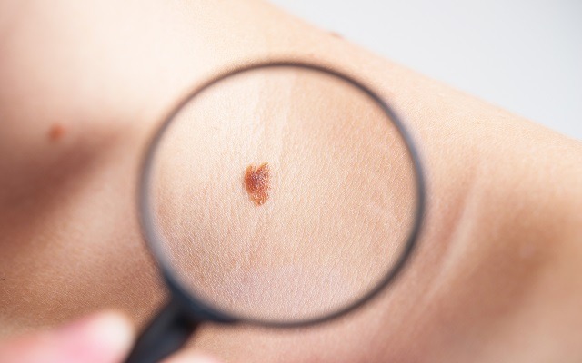 Melanoma