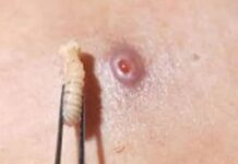 Se disparan casos de miasis; Veracruz, segundo lugar nacional