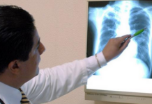 Acumula Veracruz 415 nuevos casos de tuberculosis en lo que va del año