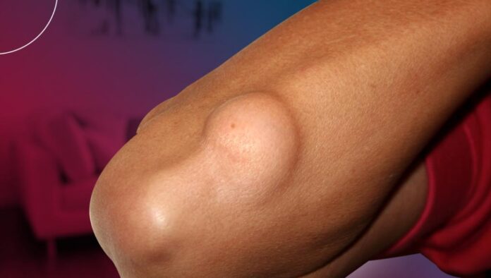 Sarcoma