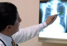 Veracruz, segundo lugar nacional en tuberculosis