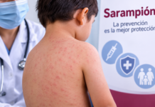 Aumenta a 76 el número de casos de sarampión en Veracruz