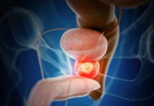 Veracruz, entre los primeros lugares en cáncer de próstata